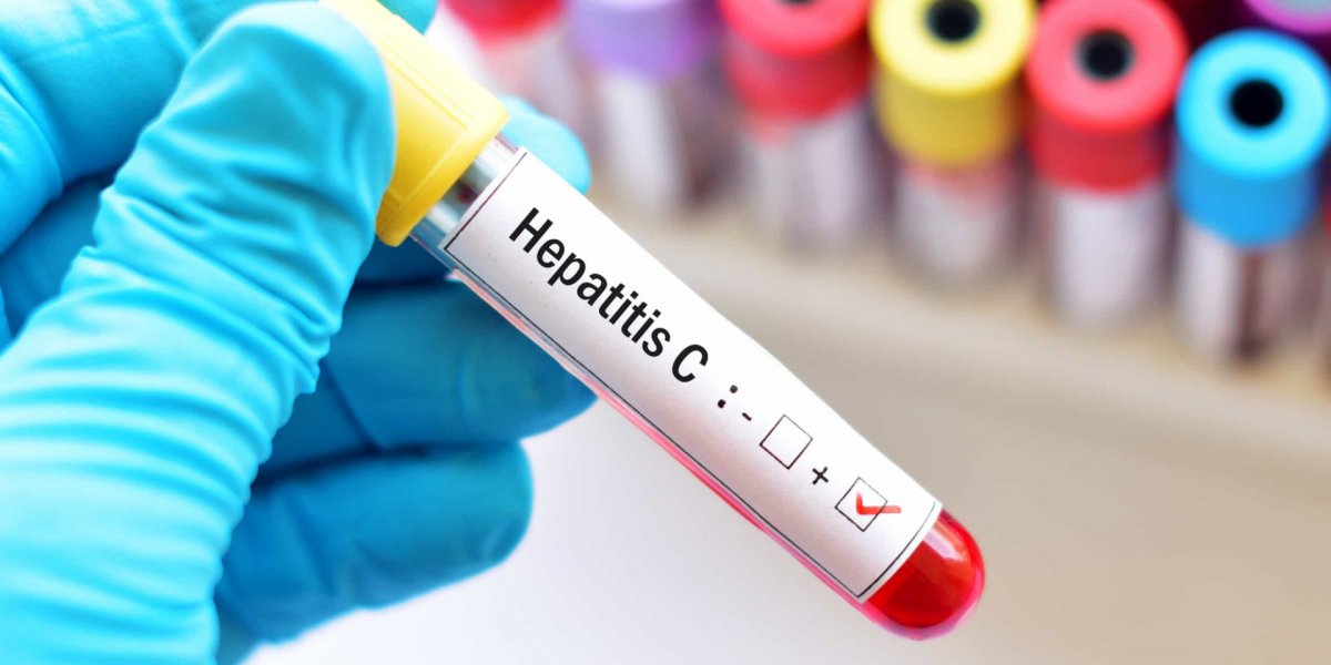 hepatite C